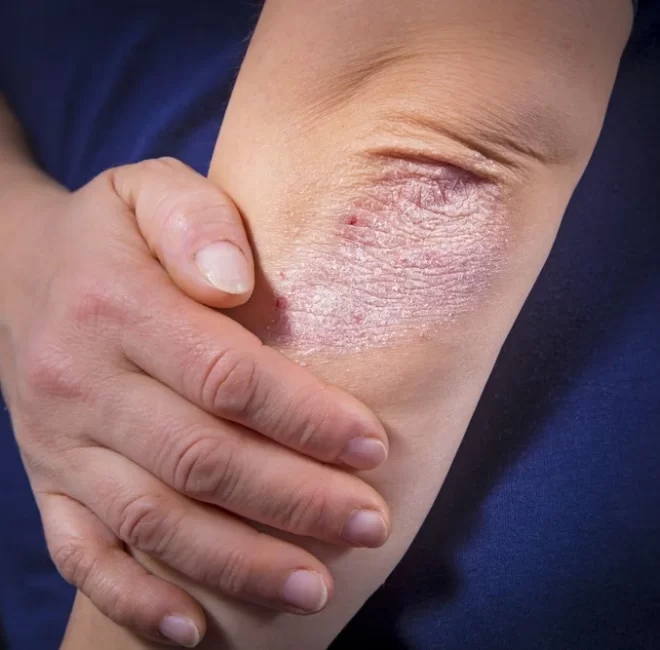 What is Psoriasis Disease and how Psoriasis Is Diagnosed?